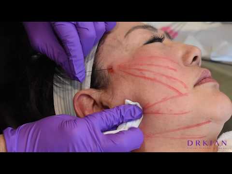 健康・医学 Thread Lifting Techniques A 3-Step Guide of 4M Thread Lift Technique for Facial