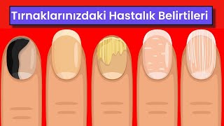 Tırnaklarınızdaki Bu Belirtiler Hastalık Belirtisi Olabilir | Sağlık | Sağlıklı Yaşam | Doktor