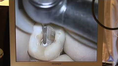 Access Refinement Radix Entomolaris with Calcification: Advanced Endodontics