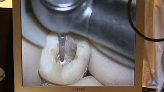 Access Refinement Radix Entomolaris with Calcification: Advanced Endodontics