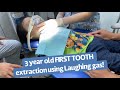 3 Year Old Toddler first tooth extraction | Kids Dentist | Laughing gas | Paw Petrol | Kids Dental