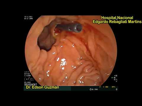 ERCP in a patient with intradiverticular papilla and distal cholangiocarcinoma