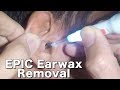 Epic Earwax Removal with Lighted Ear Curette