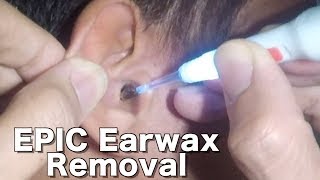 Menghilangkan Kotoran Telinga Secara Epik dengan Kuret Telinga yang Menyala