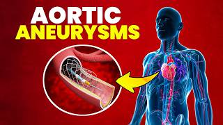 Aneurysms, The Silent Killer