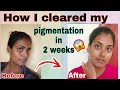 how i got rid of my pigmentation and dark spots | minimalist serum and ponds gel moisturizer review