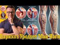 Варикоз уродует мои ноги!