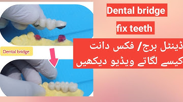 Dental bridge animated video | fix teeth |