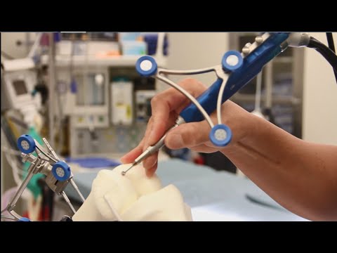Navio Robotic-Assisted Knee Replacement with Dr. James Loging - Educational Video