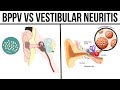 BPPV vs Vestibular Neuritis: Key Differences 🌀