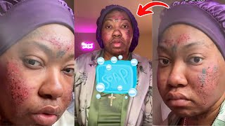 Women Gets 3rd Degree Burns From Using Acne Soap She Received Off The TikTok Shop