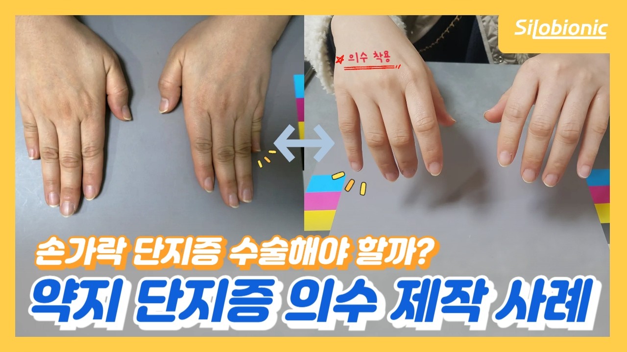 🖐️손가락 단지증 의수 제작 사례 | 약지손가락 맞춤 복원🤗 - YouTube