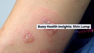 Shin Lump: Common Causes and When to Seek Medical Care  | BuoyHealth.com