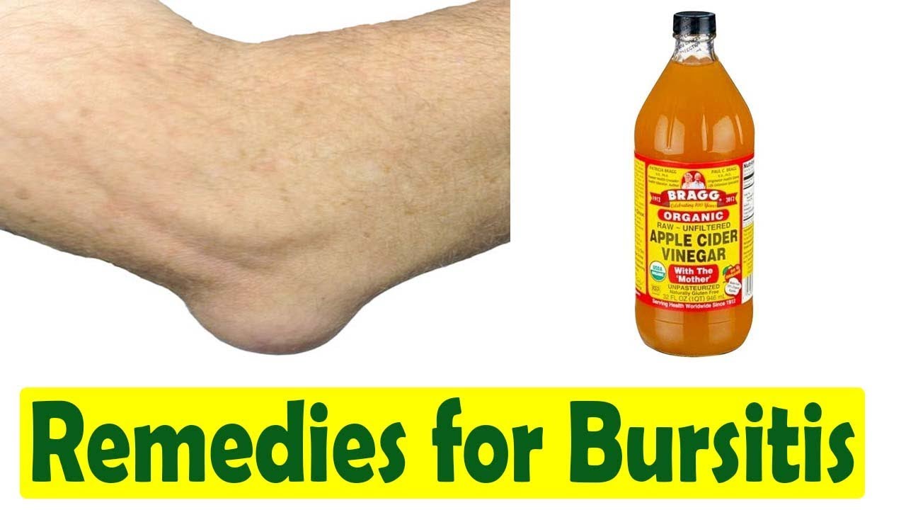 How to Cure Bursitis Home Remedies for Bursitis YouTube