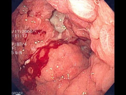 Stomach Cancer - YouTube