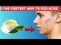 The FASTEST Way to RID ACNE
