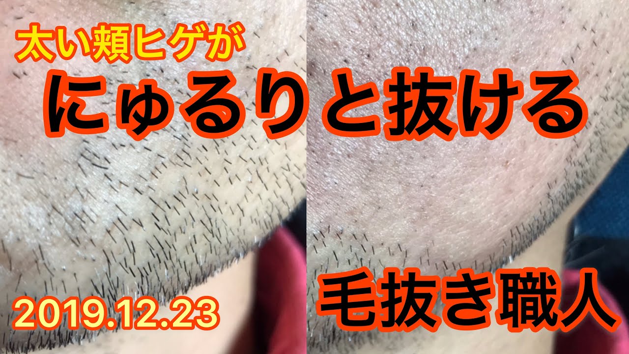 Plucking Facial Hair にゅるりと抜ける頬ヒゲ 19 12 24 毛抜き職人 Youtube