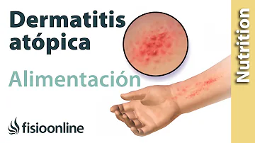 ¿Qué dieta ayuda con el eczema?