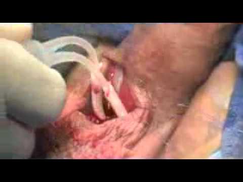 Penile Surgery