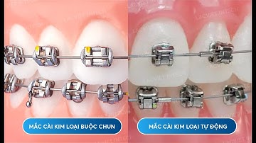 Niềng Răng Mắc Cài Kim Loại Có Tốt Không? 5 Ưu Điểm "Thần Kỳ" Mắc Cài Kim Loại (Nghe Là Muốn Niềng)