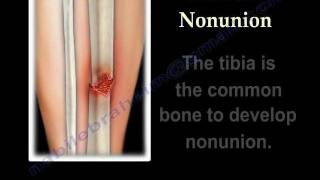 NONUNION OF FRACTURES CAUSES AND TREATMENT - Everything You Need To Know - Dr. Nabil Ebraheim