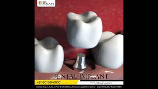 Bridges VS Implants Explained 3D  ll Dr Kasana's Clinic