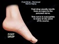 Foot Drop, peroneal nerve Injury