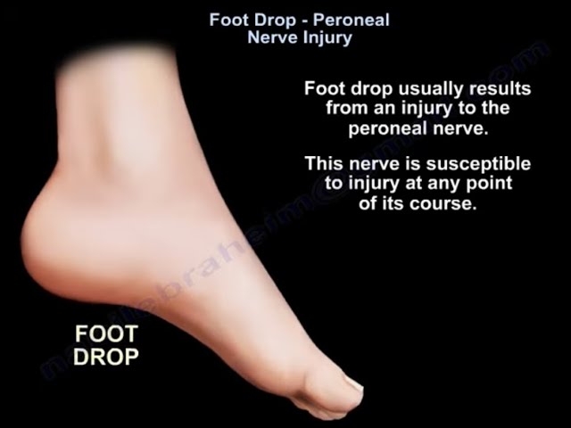 Foot Drop, peroneal nerve Injury 