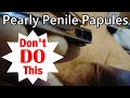 Don't Cut Your Penile Papules & See What Happens!