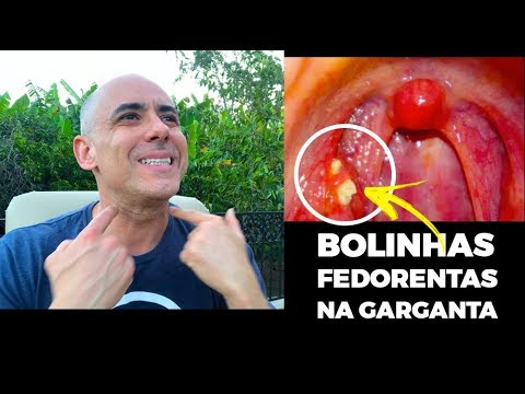 REMÉDIO CASEIRO PARA REMOVER BOLINHAS FEDORENTAS DA GARGANTA | Dr Dayan Siebra