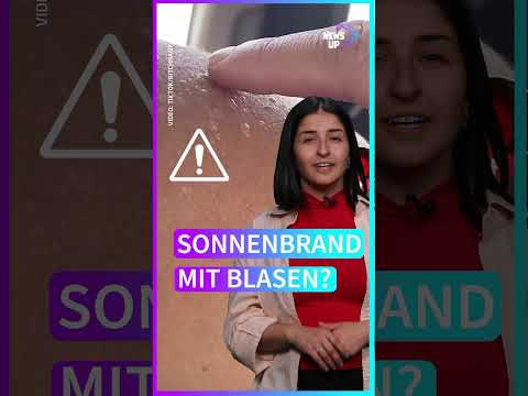 Video: Was tun bei blasenbildendem Sonnenbrand?