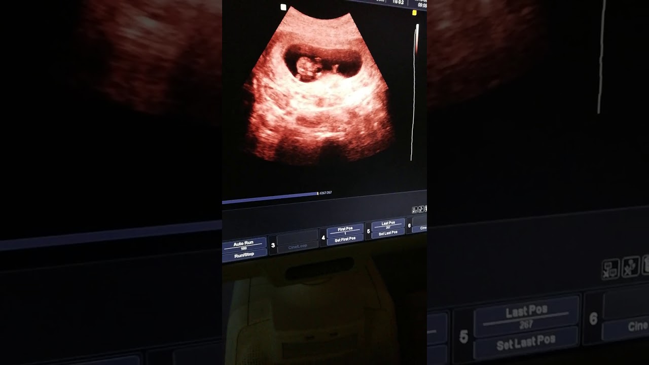 لاتخشي من وجود حاجز بالرحم ؟؟