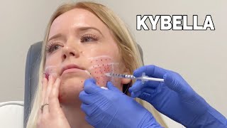 How Long does Kybella Swelling Last // Dr Rajani