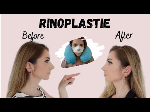 Video: Rezultatul rinoplastiei Linei