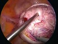 Large fibroid myomectomy with uterine artery ligation