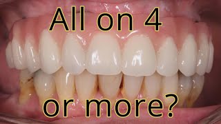 All on 4 or All on 6 or more?