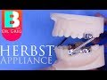 [BRACES EXPLAINED] Herbst Appliance