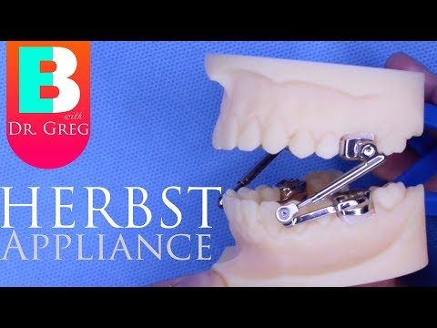 [BRACES EXPLAINED] Herbst