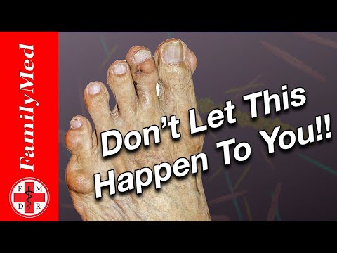 FOOT ON FIRE?  IT MIGHT BE GOUT!