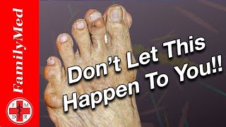 FOOT ON FIRE? IT MIGHT BE GOUT!
