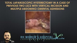 #114:TOTAL LAPAROSCOPIC HYSTERECTOMY IN A CASE OF PREVIOUS TWO LSCS WITH VERTICAL INCISION