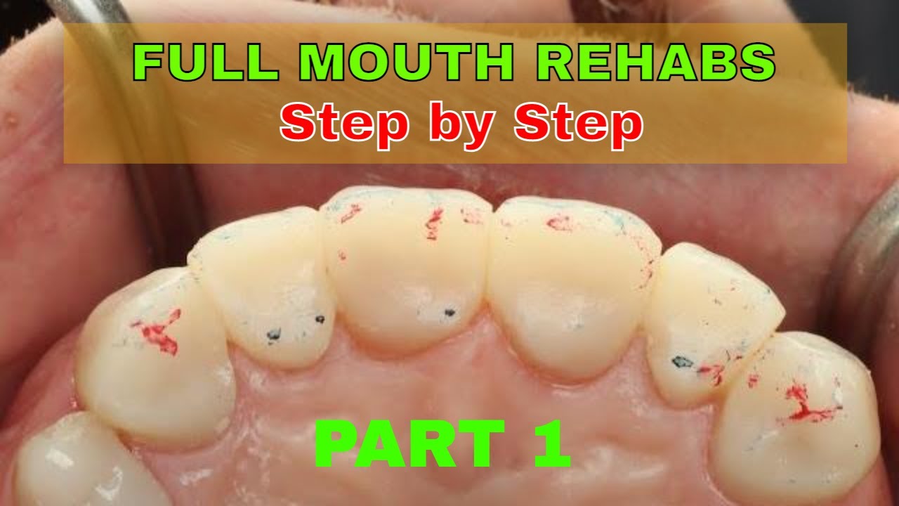 Адгезивная полная реабилитация полости рта. Часть 1 с доктором Девом Пателем