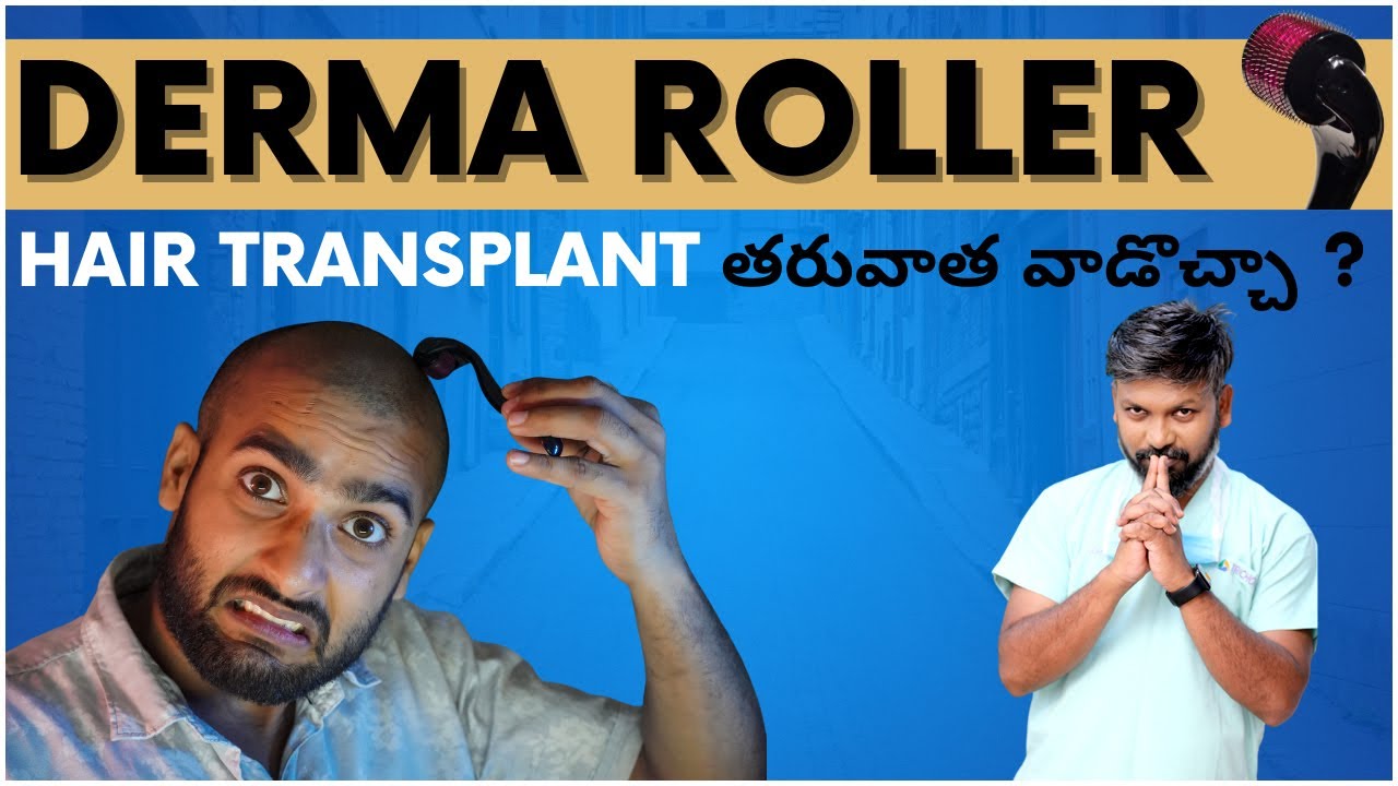 #AskDrJohnWatts | DERMA ROLLER HAIR TRANSPLANT తరువాత వాడొచ్చా ? | Hair Specialist Explains
