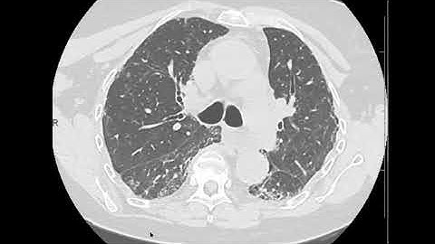 UIP evolution from NSIP on CT