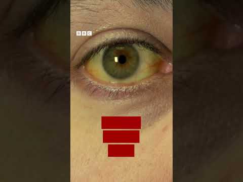 جهان سریقلیک یا هپاتیت کسللیگیگه قرشی کوره ش