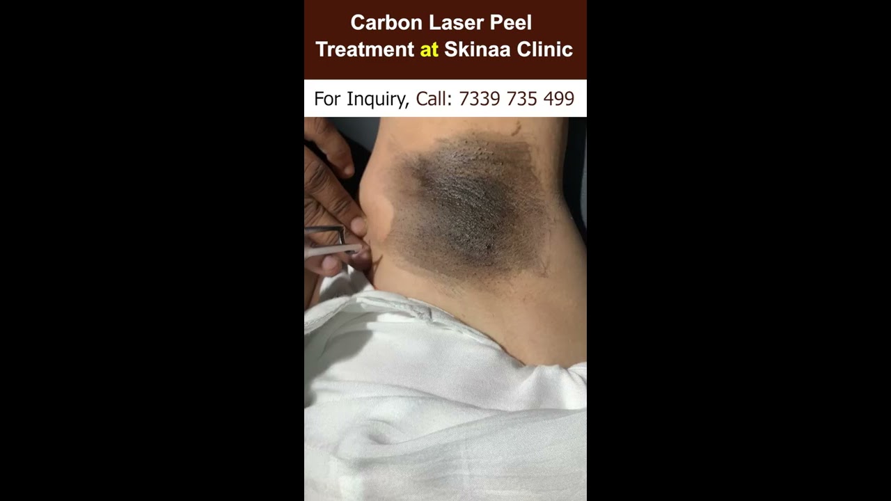 Carbon Laser Peel Treatment At Skinaa Clinic Viral Shorts