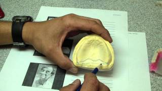 Posterior Palatal Seal screenshot 2