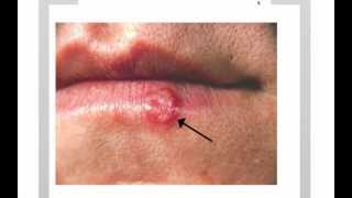 Dating a guy with genital herpes