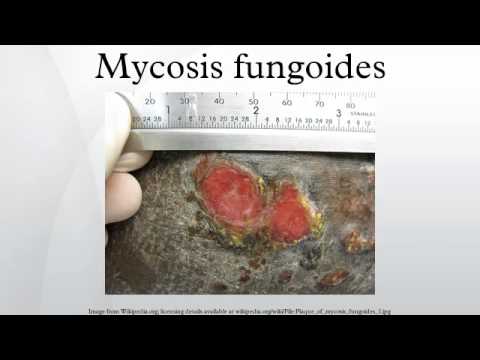 Vidéo: Peut-on mourir du mycosis fongoïde ?