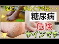 【要注意】見逃すと後悔！糖尿病による「足」の危険なサインと初期症状を医師が解説 ｜ シニアライフ